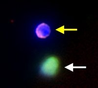 Immunofluorescence (Circulating Glioblastoma Multiforme Cell)