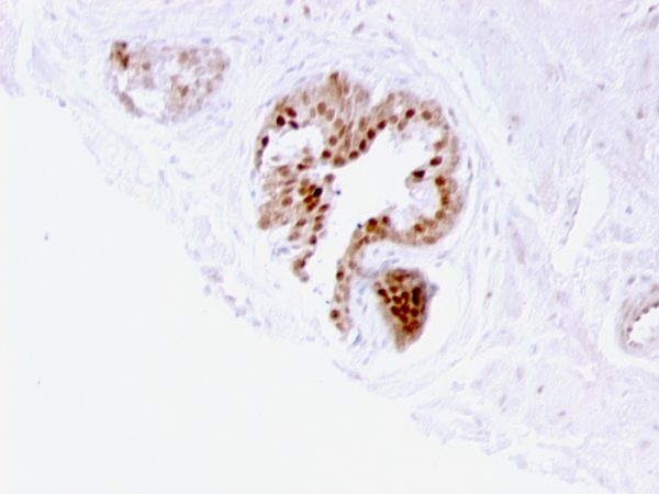 Formalin-fixed, paraffin-embedded human prostate carcinoma stained with p57 Mouse Monoclonal Antibody (57P06).