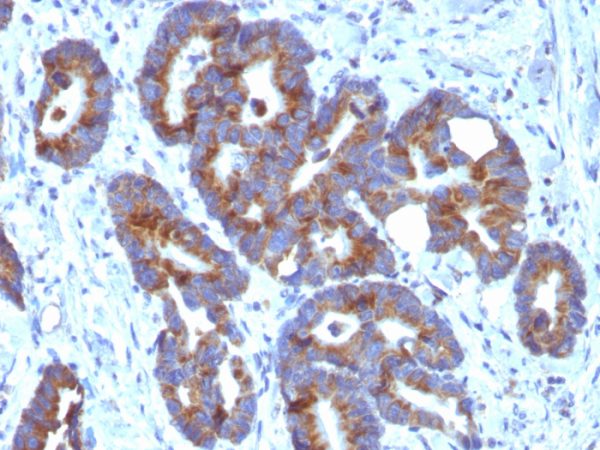 Formalin-fixed, paraffin-embedded human Colorectal Carcinoma stained with Blood Group Antigen A Monoclonal Antibody (HE-10)