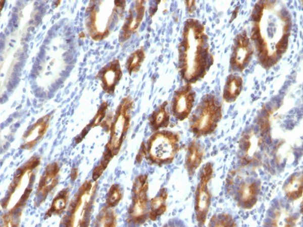 Formalin-fixed, paraffin-embedded human Gastric Carcinoma stained with MUC6 Monoclonal Antibody (MUC6/916).