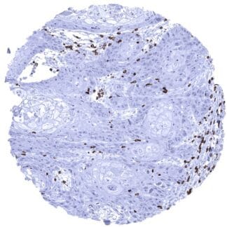 Squamous cell carcinoma containing numerous CD3 positive T-lymphocytes